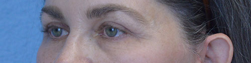 Blepharoplasty