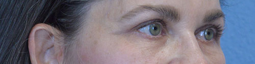 Blepharoplasty