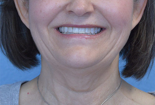 Face and Neck Lift