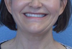 Face and Neck Lift