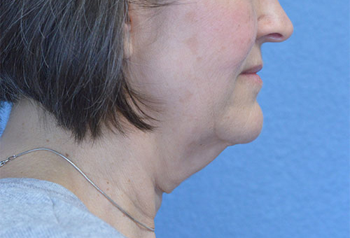 Face and Neck Lift