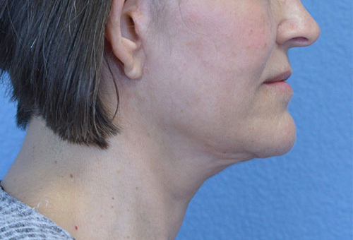 Face and Neck Lift