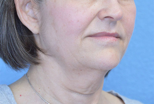 Face and Neck Lift