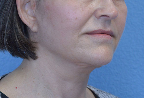 Face and Neck Lift