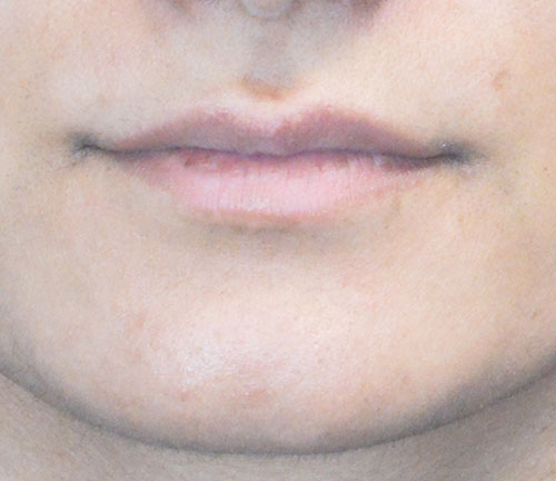 Lip Augmentation