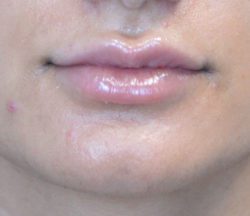 Lip Augmentation