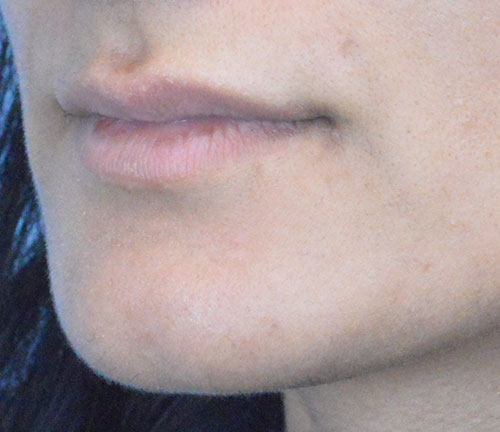 Lip Augmentation