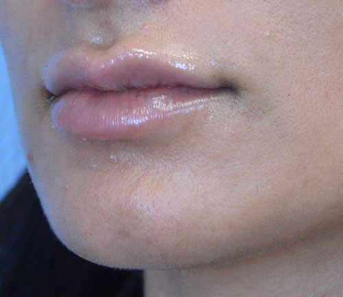 Lip Augmentation