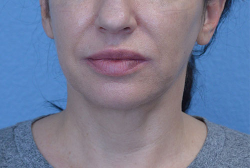 Face and Neck Lift Case 3025 Before Photo Face and Neck Lift