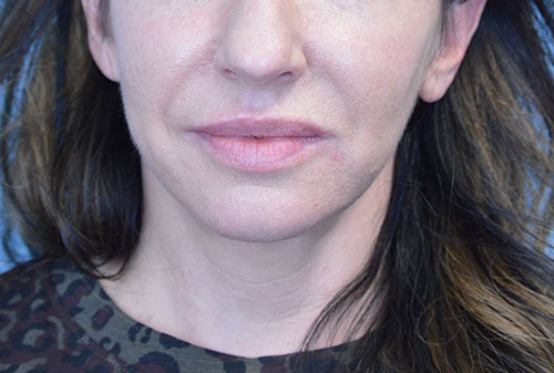 Face and Neck Lift Case 3025 After Photo Face and Neck Lift