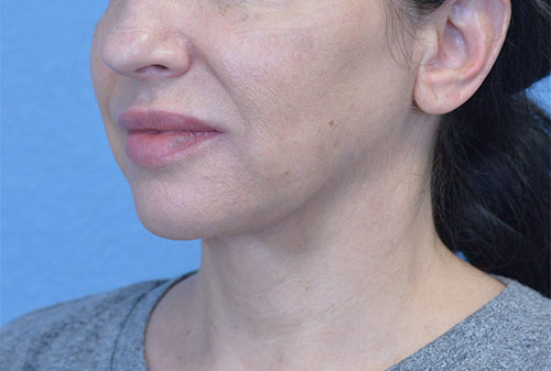 Face and Neck Lift Case 3025 Before Photo Face and Neck Lift