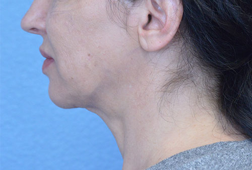 Face and Neck Lift Case 3025 Before Photo Face and Neck Lift