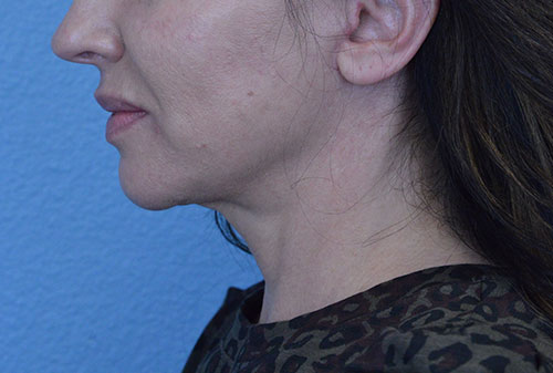 Face and Neck Lift Case 3025 After Photo Face and Neck Lift