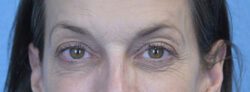 Blepharoplasty