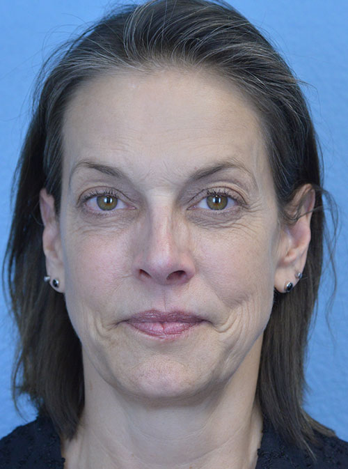 Blepharoplasty Case 2995 Before Photo Blepharoplasty
