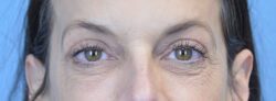 Blepharoplasty