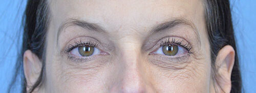 Blepharoplasty