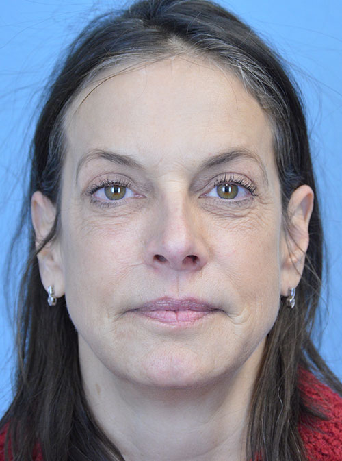 Blepharoplasty Case 2995 After Photo Blepharoplasty