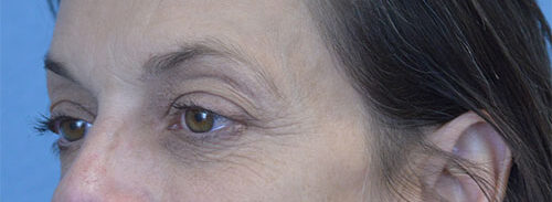 Blepharoplasty