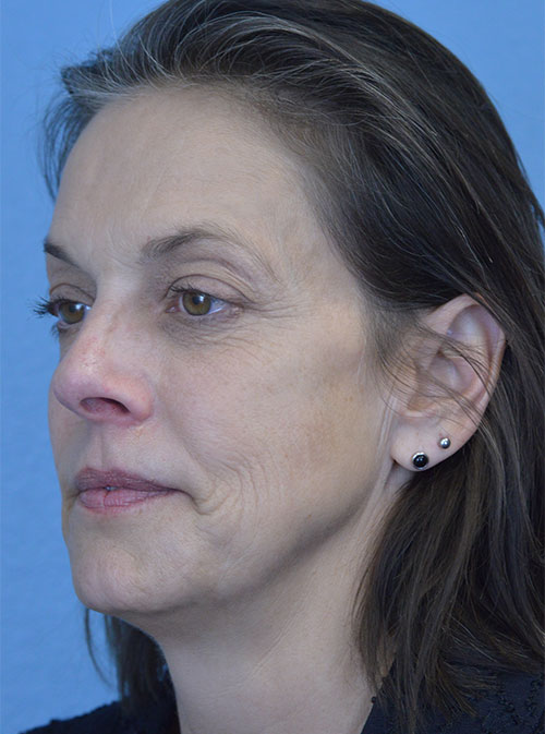 Blepharoplasty Case 2995 Before Photo Blepharoplasty