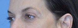 Blepharoplasty