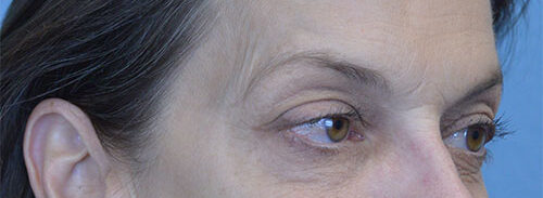 Blepharoplasty