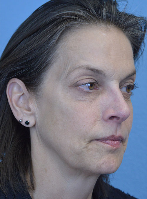 Blepharoplasty Case 2995 Before Photo Blepharoplasty