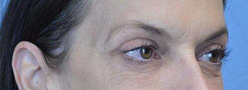 Blepharoplasty