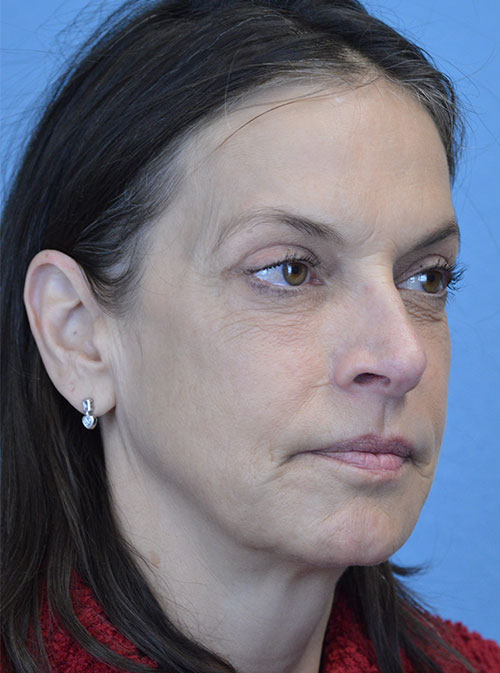 Blepharoplasty Case 2995 After Photo Blepharoplasty