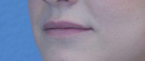 Lip Augmentation