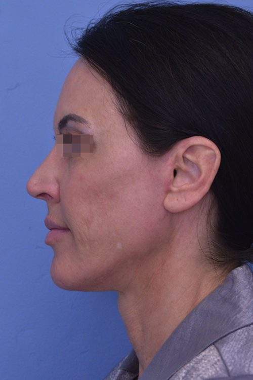 Face and Neck Lift