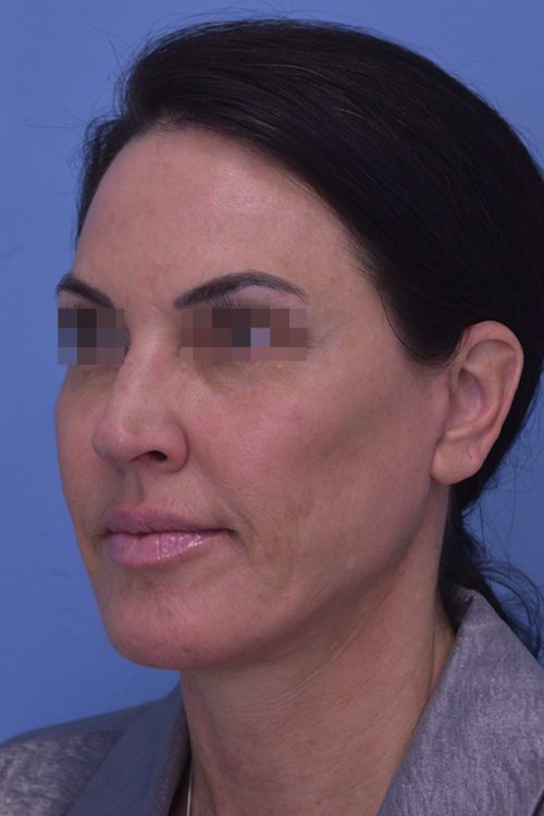 Face and Neck Lift