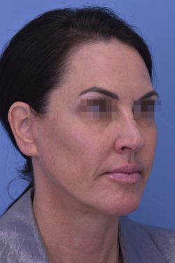 Face and Neck Lift