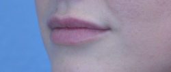 Lip Augmentation