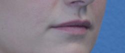 Lip Augmentation