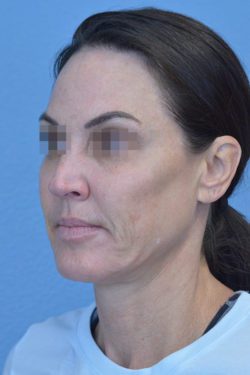 Face and Neck Lift