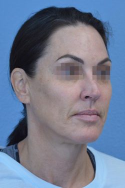 Face and Neck Lift