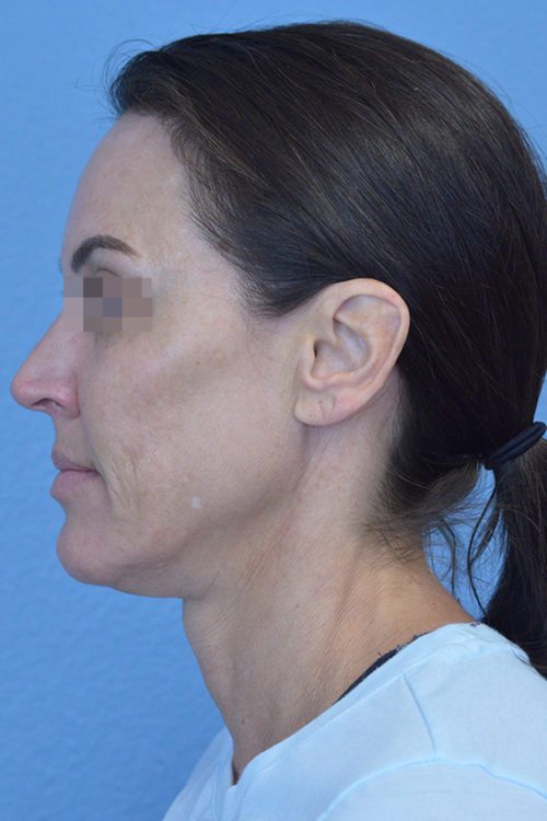 Face and Neck Lift