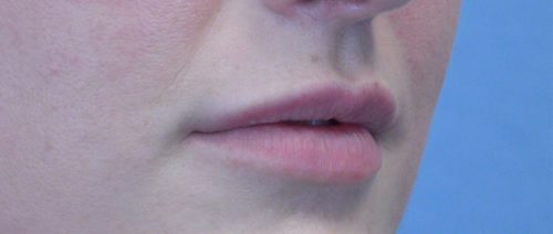 Lip Augmentation