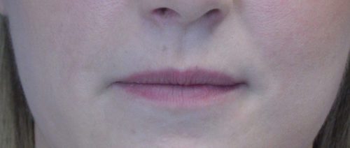 Lip Augmentation