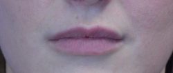 Lip Augmentation