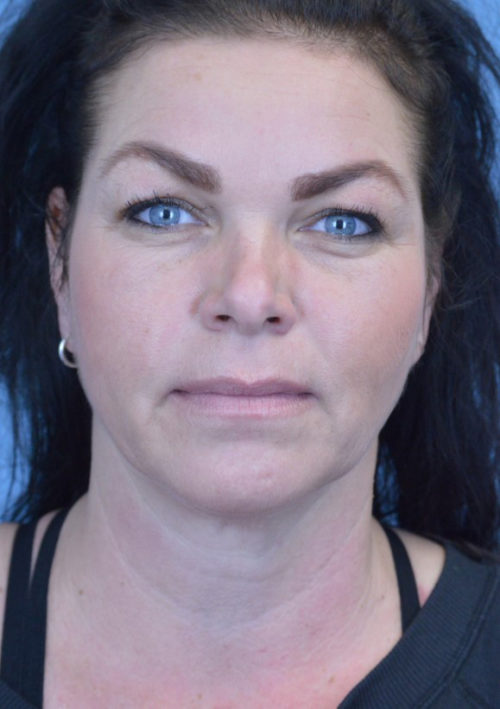 Blepharoplasty Case 3381 Before Photo Blepharoplasty