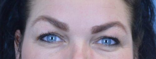 Blepharoplasty