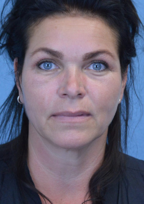 Blepharoplasty Case 3381 After Photo Blepharoplasty