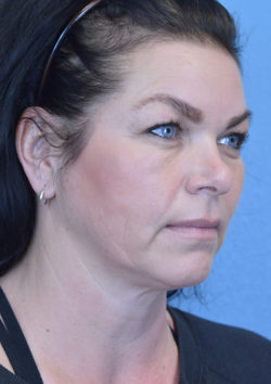 Blepharoplasty