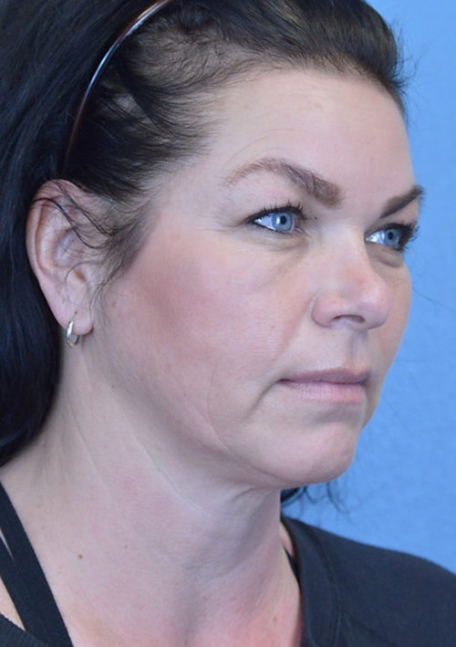 Blepharoplasty Case 3381 Before Photo Blepharoplasty