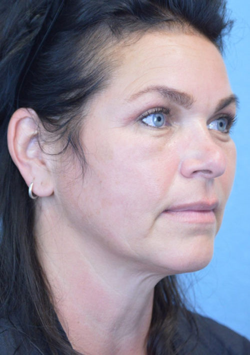 Blepharoplasty Case 3381 After Photo Blepharoplasty
