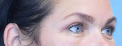 Blepharoplasty