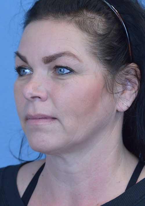 Blepharoplasty Case 3381 Before Photo Blepharoplasty