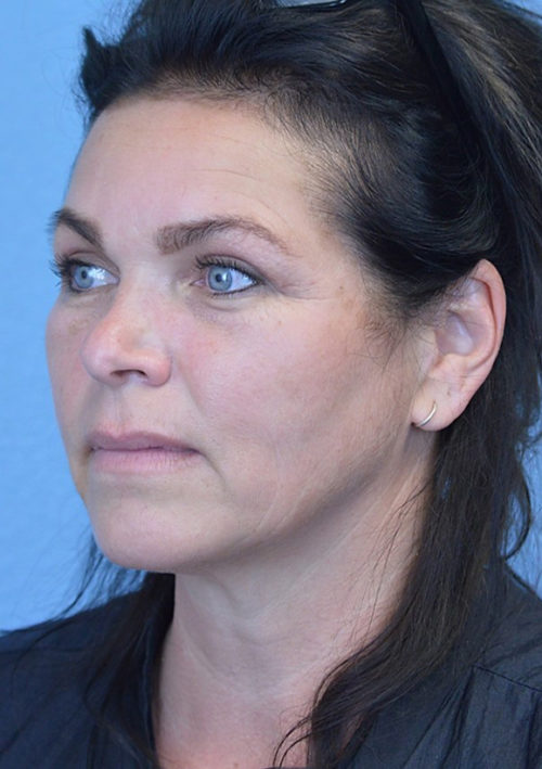 Blepharoplasty Case 3381 After Photo Blepharoplasty